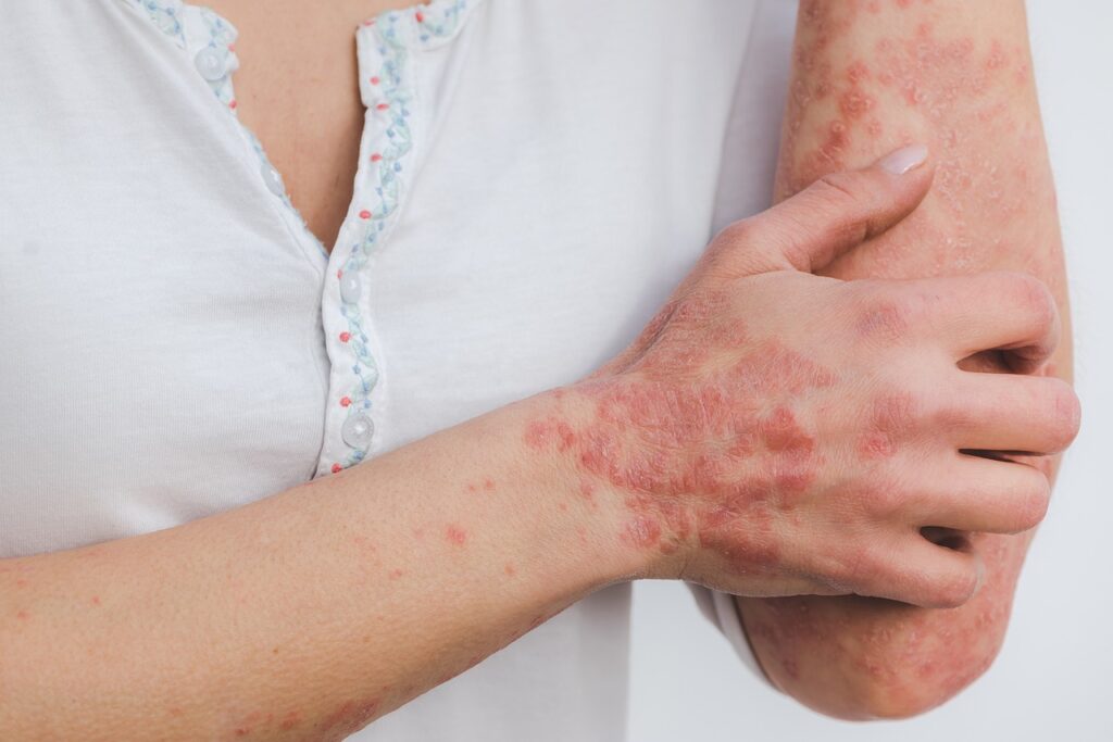 Eczema